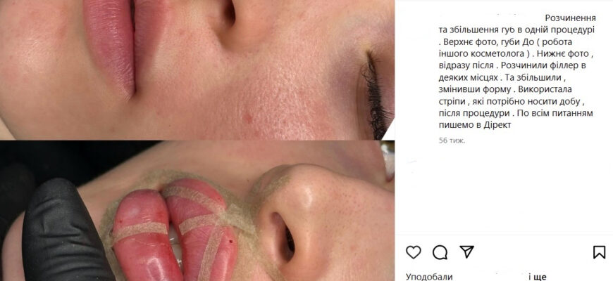 Збільшення губ: Порівняння результатів до та після процедур