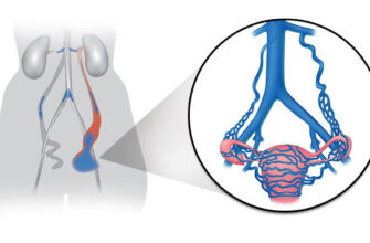Життя після емболізації: шлях до відновлення та повернення активності