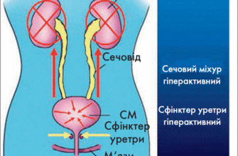 Життя після видалення сечового міхура: нові виклики та адаптація