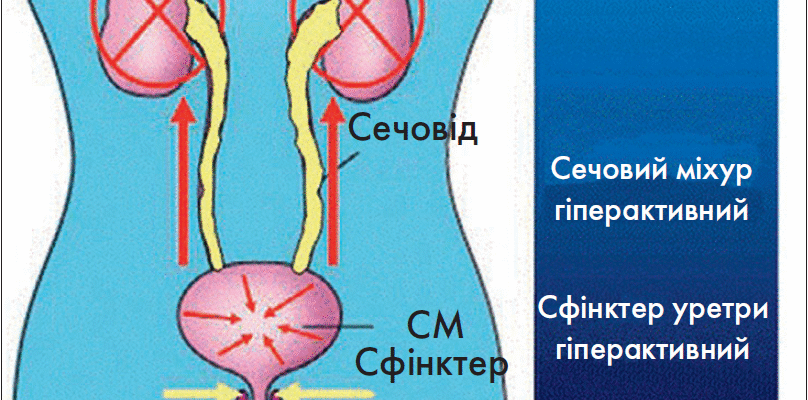 Життя після видалення сечового міхура: нові виклики та адаптація