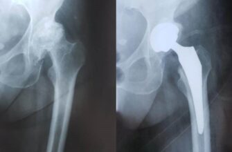 Життя після заміни кульшового суглоба: відновлення та поради лікарів