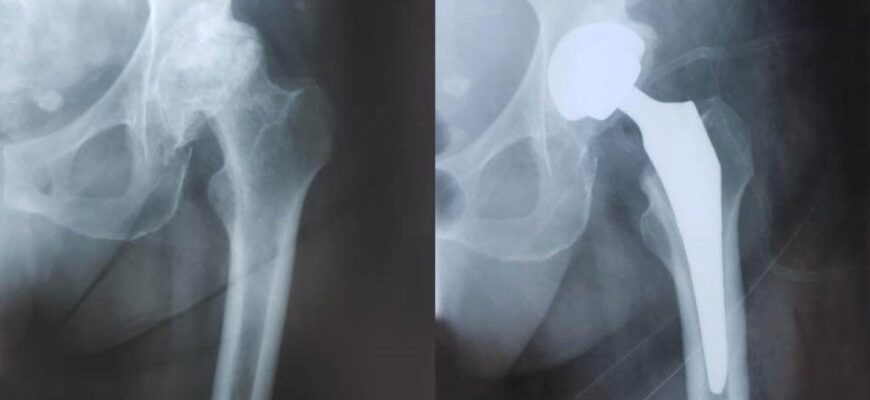 Життя після заміни кульшового суглоба: відновлення та поради лікарів
