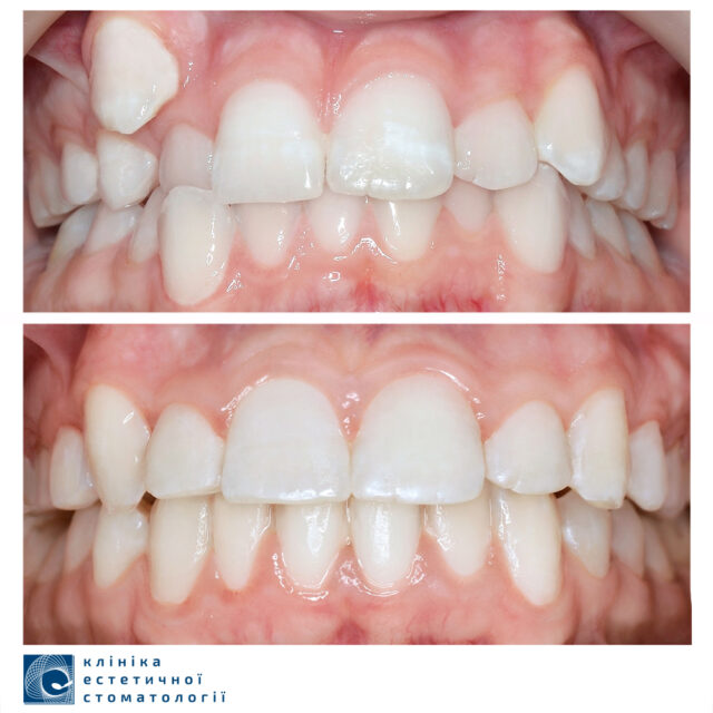 Перехресний прикус: симптоми, діагностика та лікування