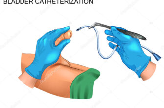 Зняття сечового катетера у чоловіків: покрокова інструкція та поради