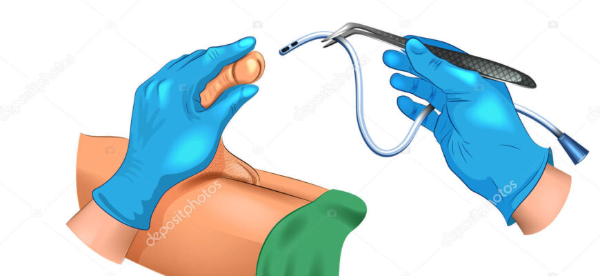 Зняття сечового катетера у чоловіків: покрокова інструкція та поради