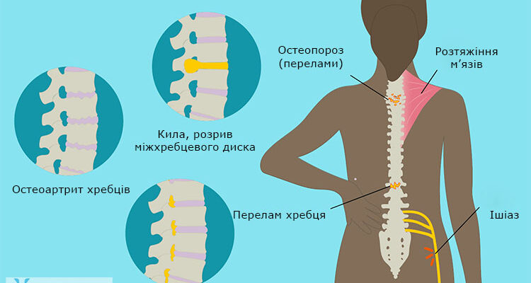Зняти біль у спині внизу: ефективні методи та рекомендації