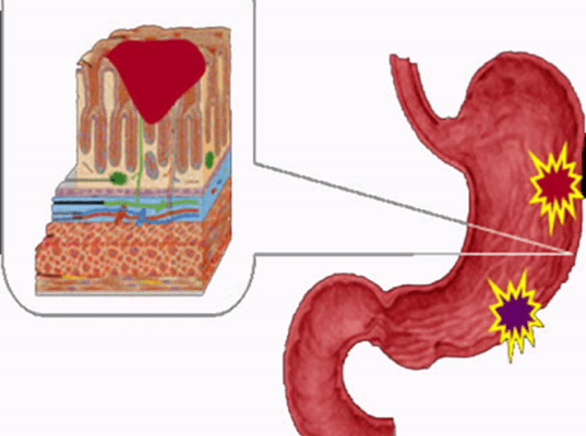 Біль в животі після їжі: можливі причини та ефективні рішення