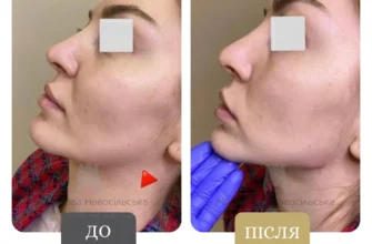 Чому не рекомендовано вживати алкоголь після процедур ботоксу?