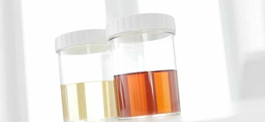 Чому сеча має неприємний запах: основні причини та що робити?