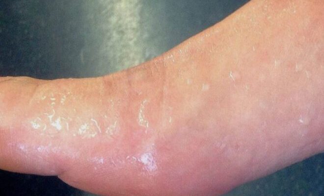 Чи безпечно їсти банани після операції апендициту: поради лікарів