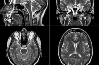 Чи безпечно робити МРТ з металокерамічними зубними коронками?