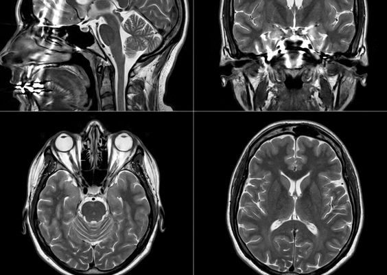 Чи безпечно робити МРТ з металокерамічними зубними коронками?