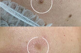 Чи безпечно видаляти родимки на обличчі: поради та рекомендації