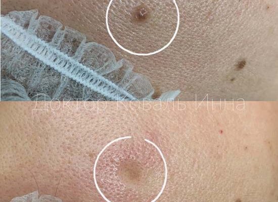 Чи безпечно видаляти родимки на обличчі: поради та рекомендації Чи безпечно видаляти родимки на обличчі: поради та рекомендації