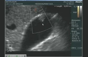 Чи дозволено пити каву перед УЗД черевної порожнини: що потрібно знати?