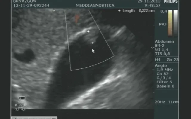 Чи дозволено пити каву перед УЗД черевної порожнини: що потрібно знати?