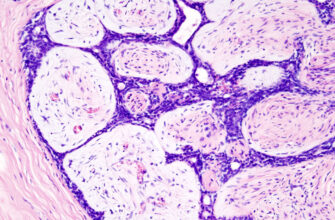 Чи може фіброаденома зникнути: факти та можливості лікування
