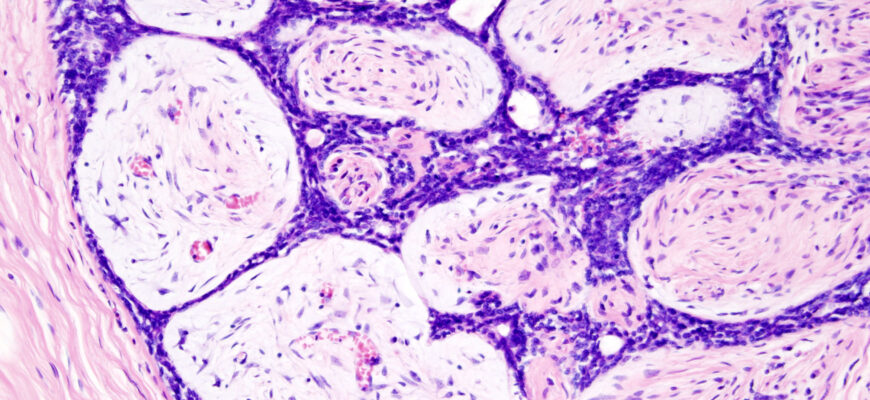 Чи може фіброаденома зникнути: факти та можливості лікування