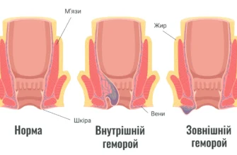 Чи може геморой зникнути самостійно: пояснюємо причини та наслідки