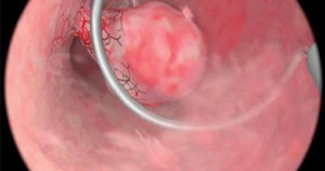 Чи може поліп вийти під час місячних: відповіді лікарів та поради