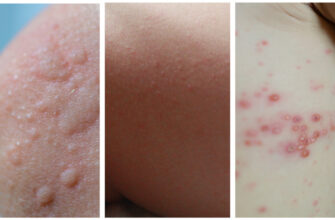 Чи може вітрянка протікати без температури: факти та міфи