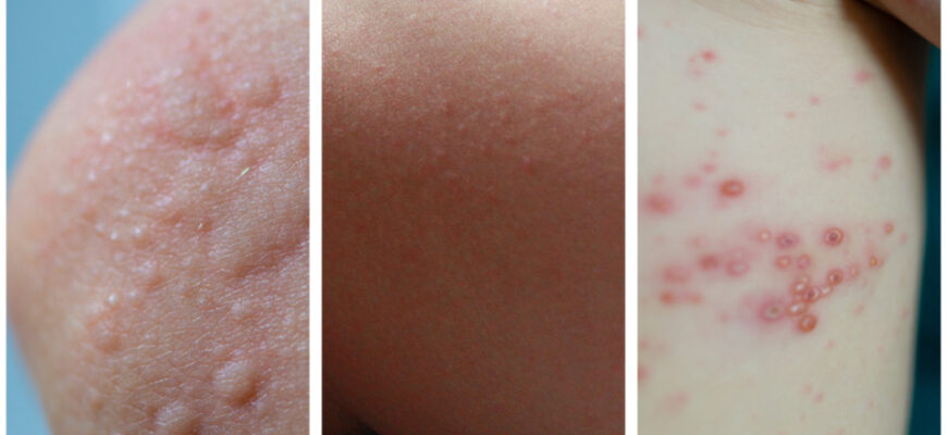 Чи може вітрянка протікати без температури: факти та міфи