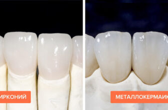Чи можливе підпилювання цирконієвої коронки: безпечність та нюанси