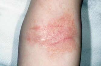 Чи можливо повністю вилікувати нейродерміт: сучасні методи терапії