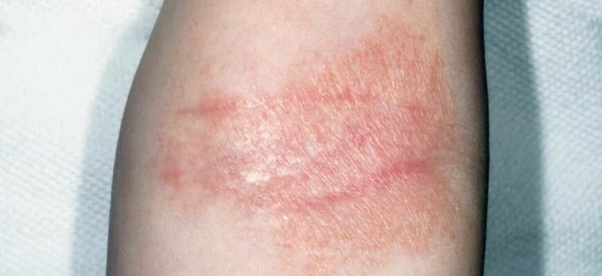 Чи можливо повністю вилікувати нейродерміт: сучасні методи терапії