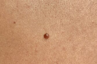 Чи можна безпечно видаляти родимки: рекомендації та застереження