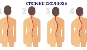 Чи можна ефективно вилікувати сколіоз 2 ступеня: поради та методи