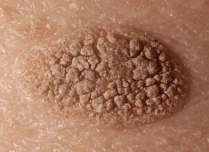 Чи можна вилікувати актинічний кератоз: сучасні методи і рекомендації