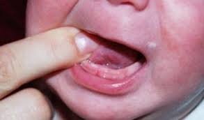 Чи можуть лізти зубки у 3 місяці: ознаки раннього прорізування