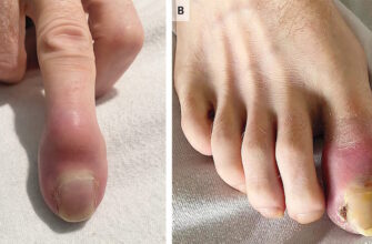 Чи можуть зникнути метастази: нові підходи в лікуванні раку