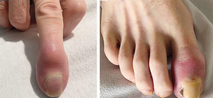 Чи можуть зникнути метастази: нові підходи в лікуванні раку