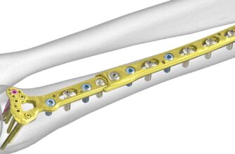 Чи обов’язково видаляти титанові пластини після операції: поради лікарів