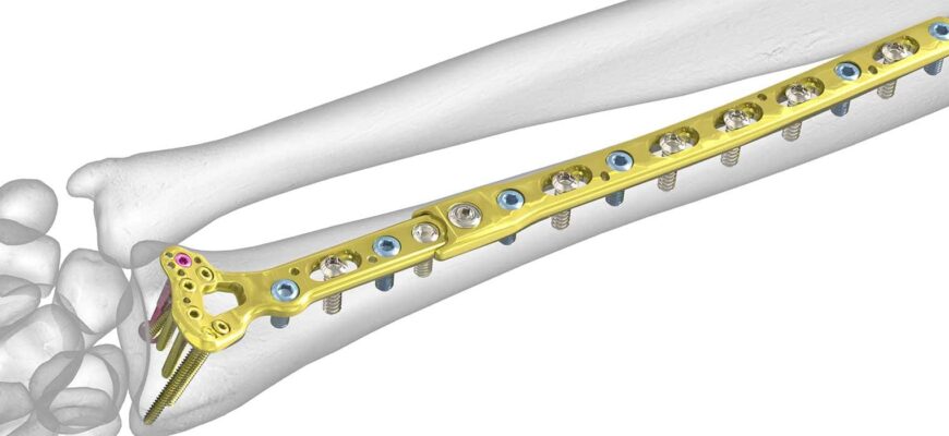 Чи обов’язково видаляти титанові пластини після операції: поради лікарів