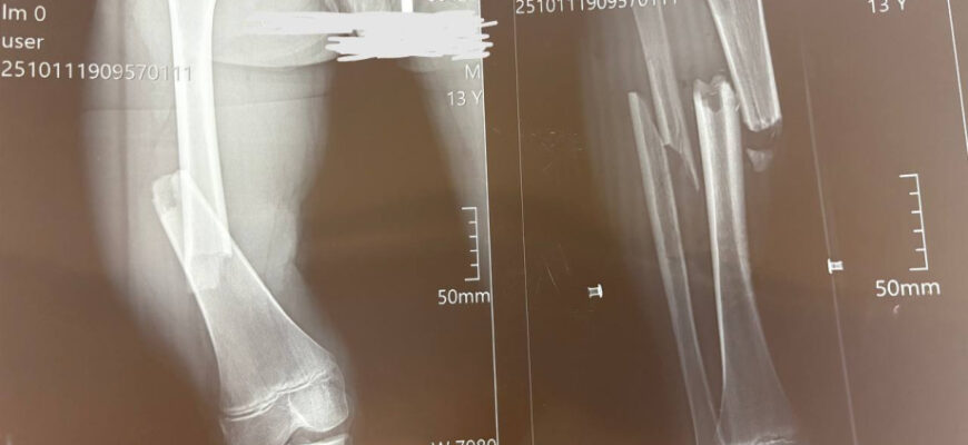 Чи потрібно видаляти остеосинтез: розвінчуємо медичні міфи та факти