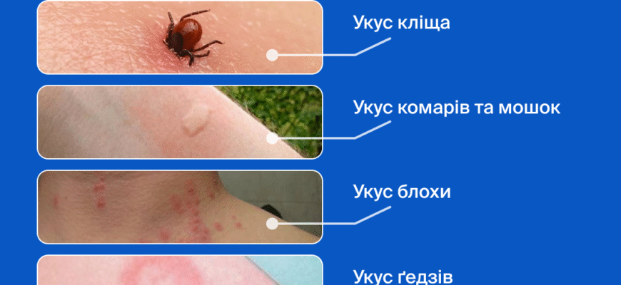 Чи варто приймати антибіотик після укусу кліща: поради та рекомендації