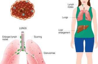 Чи виліковується саркоїдоз: сучасні методи та результати лікування