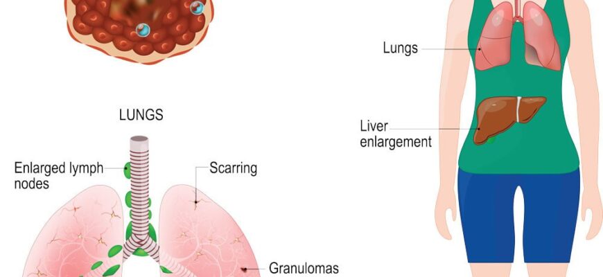 Чи виліковується саркоїдоз: сучасні методи та результати лікування