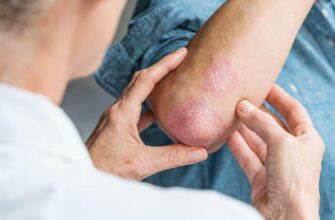 Чи заразний псоріаз: правда про передачу та способи захисту