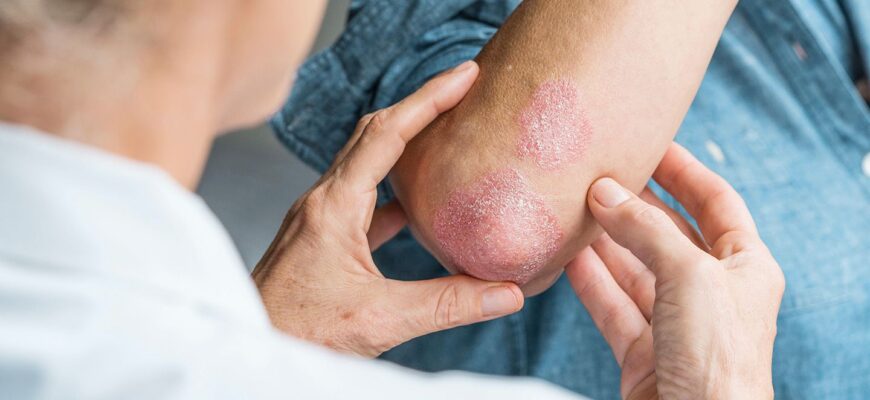 Чи заразний псоріаз: правда про передачу та способи захисту