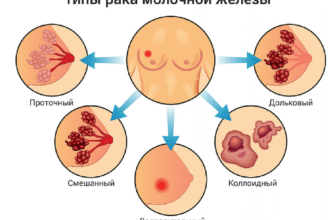 Чи здатна кіста в грудях перерости в рак: ознаки та ризики для жінок