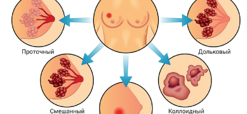Чи здатна кіста в грудях перерости в рак: ознаки та ризики для жінок