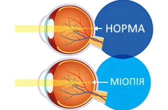 До якого віку зазвичай триває прогресування міопії: діагностика та поради