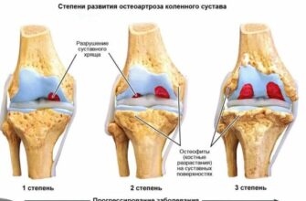 Ефективні методи лікування остеопорозу: чи реально побороти хворобу?
