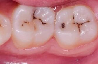 Екзостоз після видалення зуба: причини, симптоми та лікування