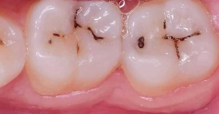 Екзостоз після видалення зуба: причини, симптоми та лікування
