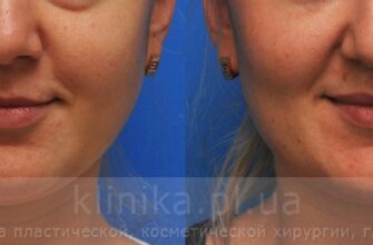 Фото до та після видалення комків Біша: результати та враження